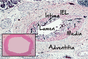 Post-mortem image shows significant narrowing of the artery in an infant with GACI due to buildup of calcium crystals between the vessel wall’s inner and middle layers. Inset: Normal non-calcified artery. Patients with GACI lack the protein ENPP1, which is responsible for creating pyrophosphate. Pyrophosphate plays a critical role in preventing calcium crystallization and accumulation.