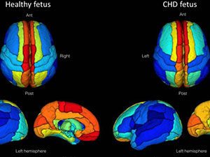 chd_fetus