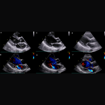 Parasternal long axis echocardiographic still frames in early systole in black and white and color Doppler of RHD-positive index case, sibling, and mother.