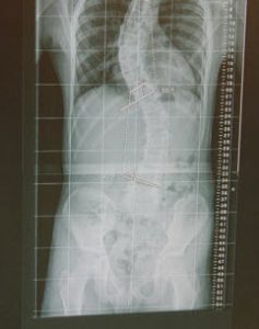 MAGEC Spinal Growing Rod Inside Boy