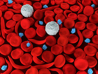 Sickle-Cell-Blood-Cells