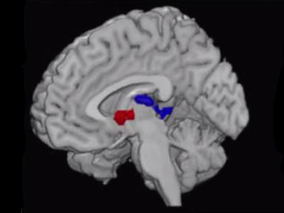 Adolescent brain scan from obesity study
