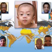 facial recognition of noonan syndrome