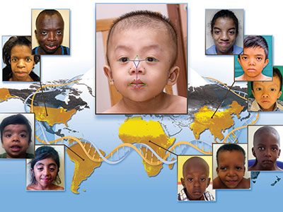 facial recognition of noonan syndrome