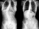 Scoliosis X-ray image