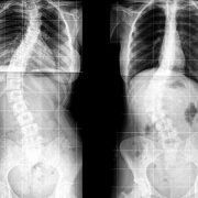 Scoliosis X-ray image