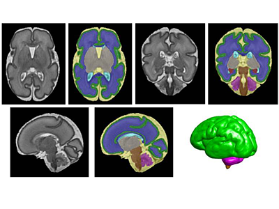 preterm brain scans