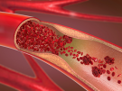 3d illustration of a constricted and narrowed artery