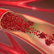 3d illustration of a constricted and narrowed artery
