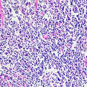 Hodgkin lymphoma cells