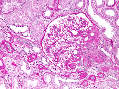 High magnification micrograph of focal segmental glomerulosclerosis