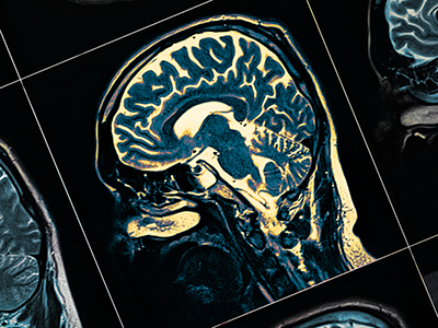 MRI of the patient's head close-up