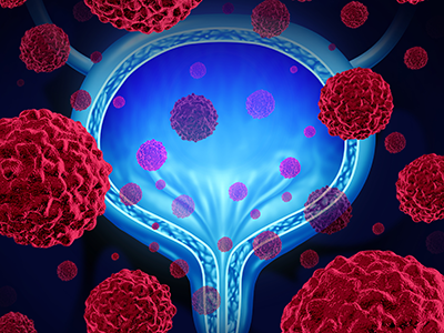 conceptual image of bladder cancer