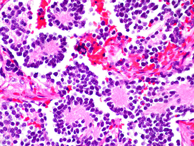 "Neuroblastoma of the Adrenal Gland (2)" by euthman is licensed under CC BY 2.0