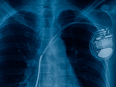 chest x-ray showing pacemaker