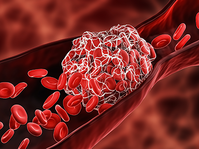 Blood Clot or thrombus