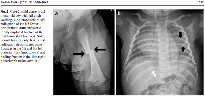 x-rays of fractures