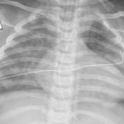 x-ray of child's chest with COVID