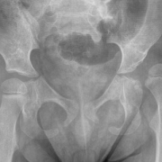 x-ray of child with dislocated hip
