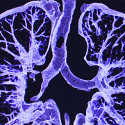 lung ct scan