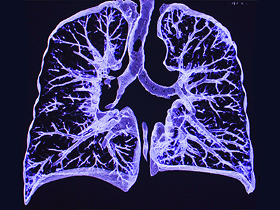 lung ct scan