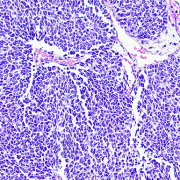 histological image of Wilms Tumor
