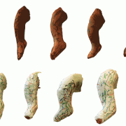 images of baby's legs and casts