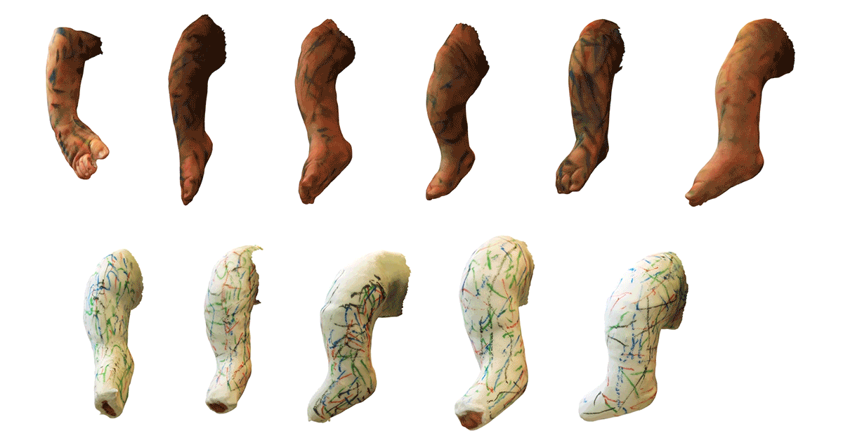 Innovation in clubfoot management using 3D anatomical mapping