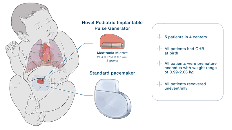 infographic explaining tiny pacemaker