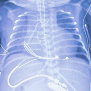 chest x-ray showing placement of tiny pacemaker