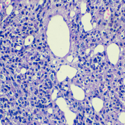 Germ cell tumor of testicle under microscopy