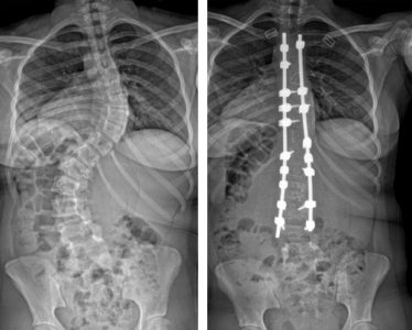 x-ray of a patient with a right thoracic deformity 