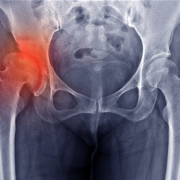x-ray showing a hip