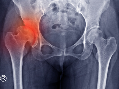x-ray showing a hip