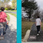Before and after pictures of the patient's improved gait