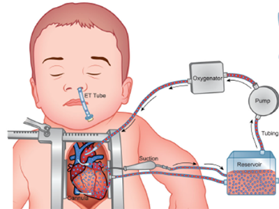 Illustration showing phthalate exposure during cardiopulmonary bypass