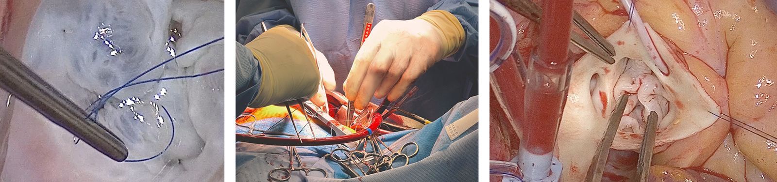 Photos of pediatric heart valve repairs