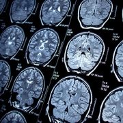 Magnetic resonance imaging of a brain with seizures