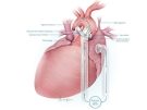 Illustration of VAD and heart