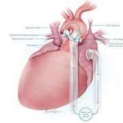 Illustration of VAD and heart