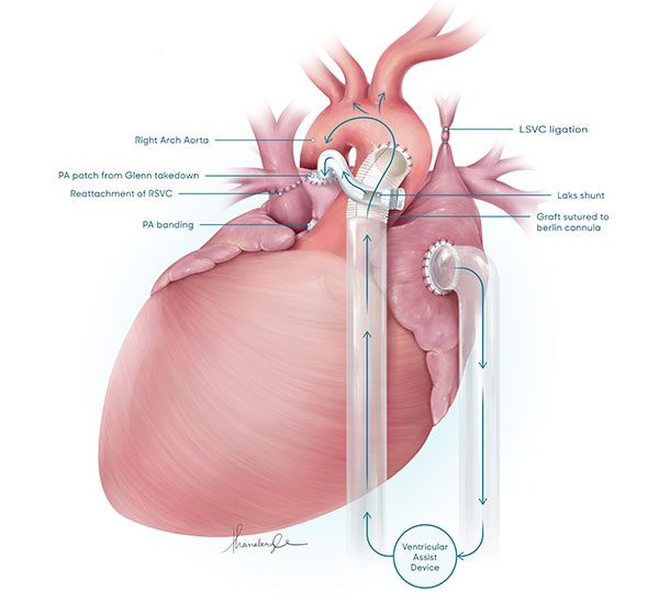 Illustration of VAD and heart