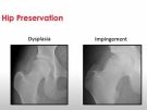 X-rays showing hip dysplasia and hip impingement