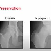 X-rays showing hip dysplasia and hip impingement