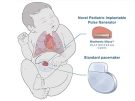 illustration of tiny pacemaker