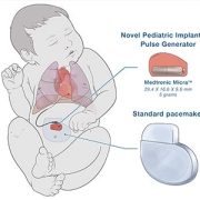 illustration of tiny pacemaker