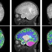brain scan of newborn