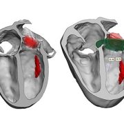 3D model for heart valve replacement planning