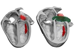 3D model for heart valve replacement planning