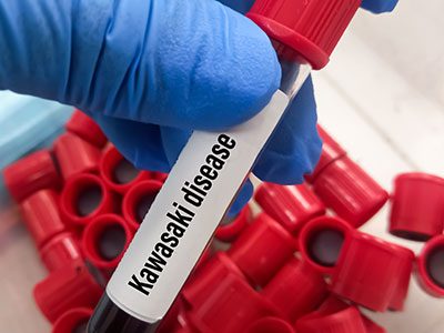 Blood sample for Kawasaki disease test,