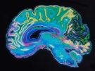 MRI image of a brain on a black background